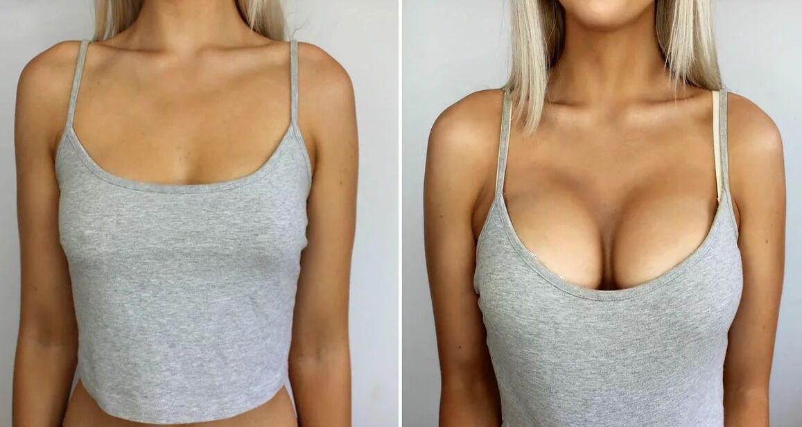 Laki ng Pagpapalaki ng Breast