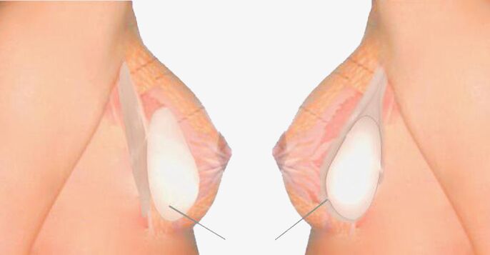 Ano ang mammoplasty