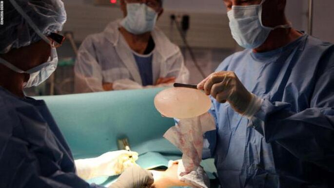 Mga tampok ng mammoplasty